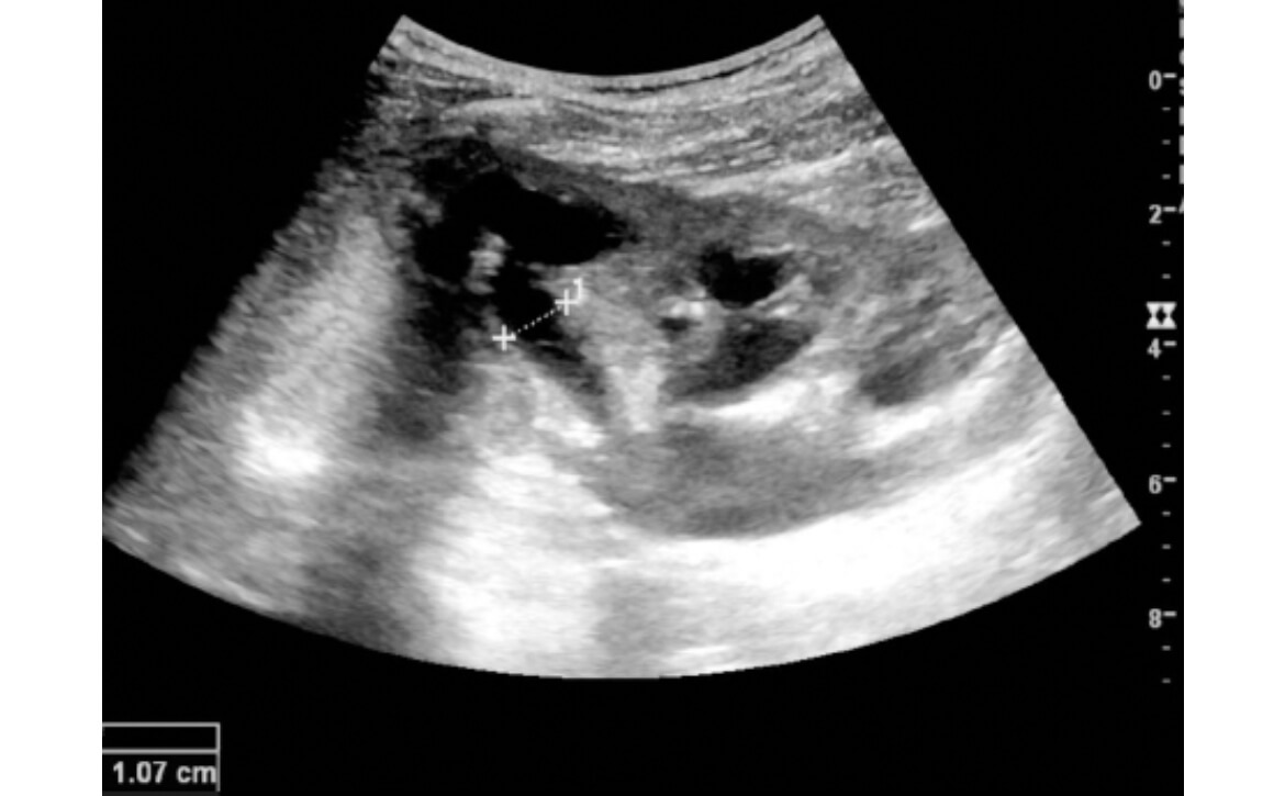 Best Pediatric Urologist in India, Robotic pediatric urology